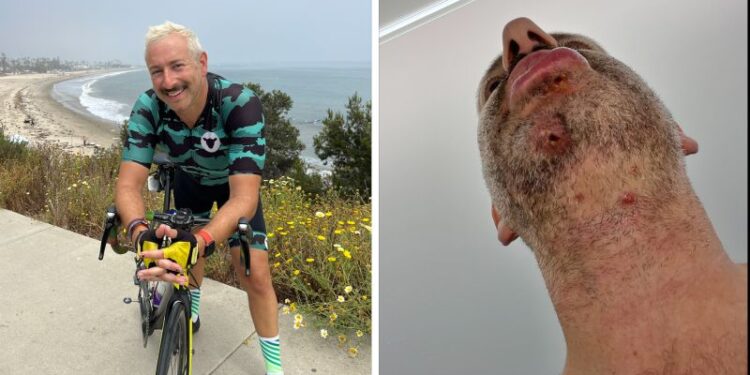 Mpox in the United States Fast Facts | CNN